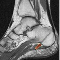 Stress fracture of your heel bone